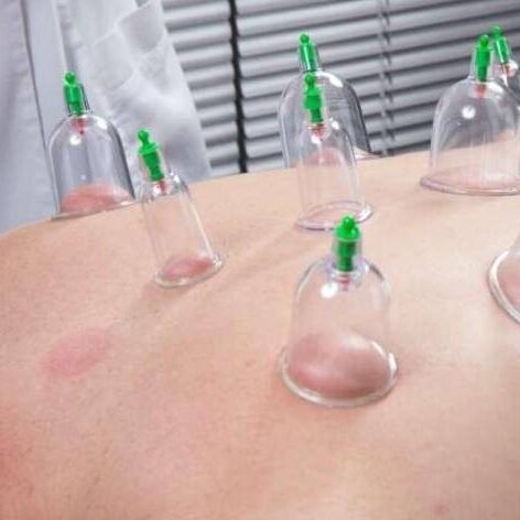 Ventosas relaxantes (ventosaterapia) aplicadas nas costas de um paciente
