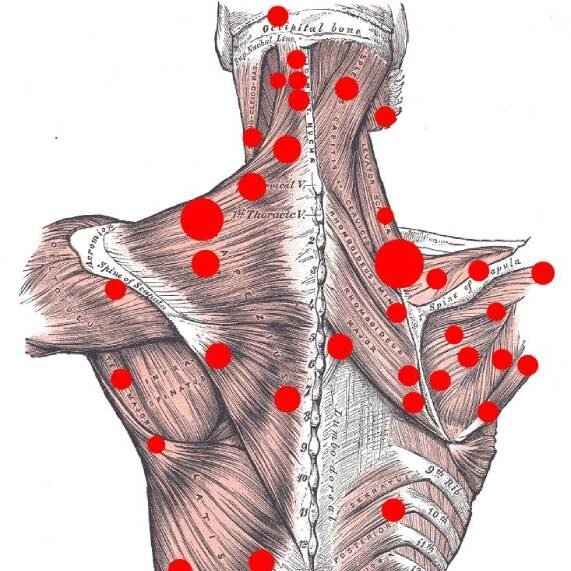 Ilustração da anatomia muscular humana e vários pontos vermelhos em destaque, representando pontos gatilho