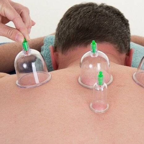 Ventosas sendo aplicadas nas costas e no trapézio de um paciente por um massoterapeuta do Espaço Leocádio