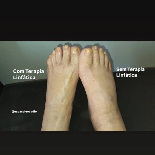 Comparação entre pé esquerdo e direto, mostrando a diferença de aplicação de drenagem linfática manual no Espaço Leocadio
