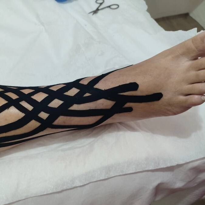 Taping linfático aplicado nas panturrilhas de uma mulher