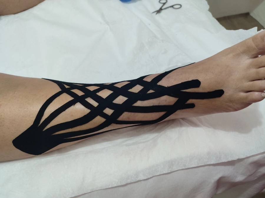 Taping linfático aplicado nas panturrilhas de uma mulher