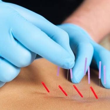 Aplicação de Dry Needling (agulhamento a seco) em um paciente com dor no Espaço Leocádio